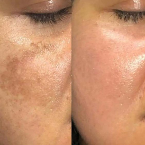 Depigmentation Treatment