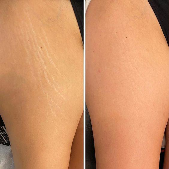 Stretchmark Eraser Treatment